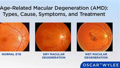 Everything You Need to Know About Macular Degeneration—Causes, Symptoms, and Treatment